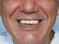 Patient's teeth after dental bridge shows all teeth present