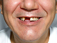 Patient's teeth before dental bridge shows gap in teeth