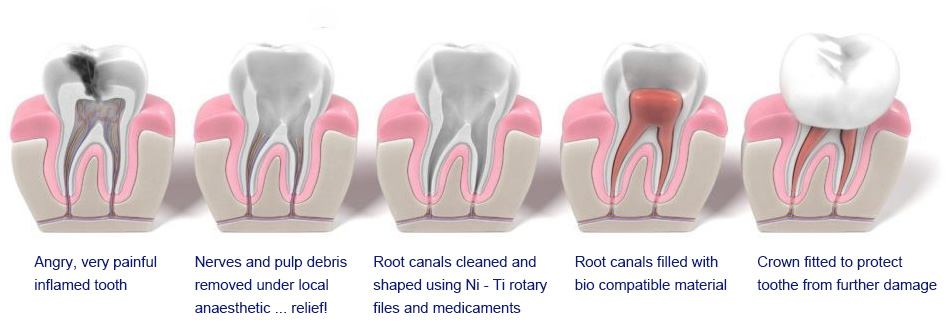 Various stages of root canal treatment