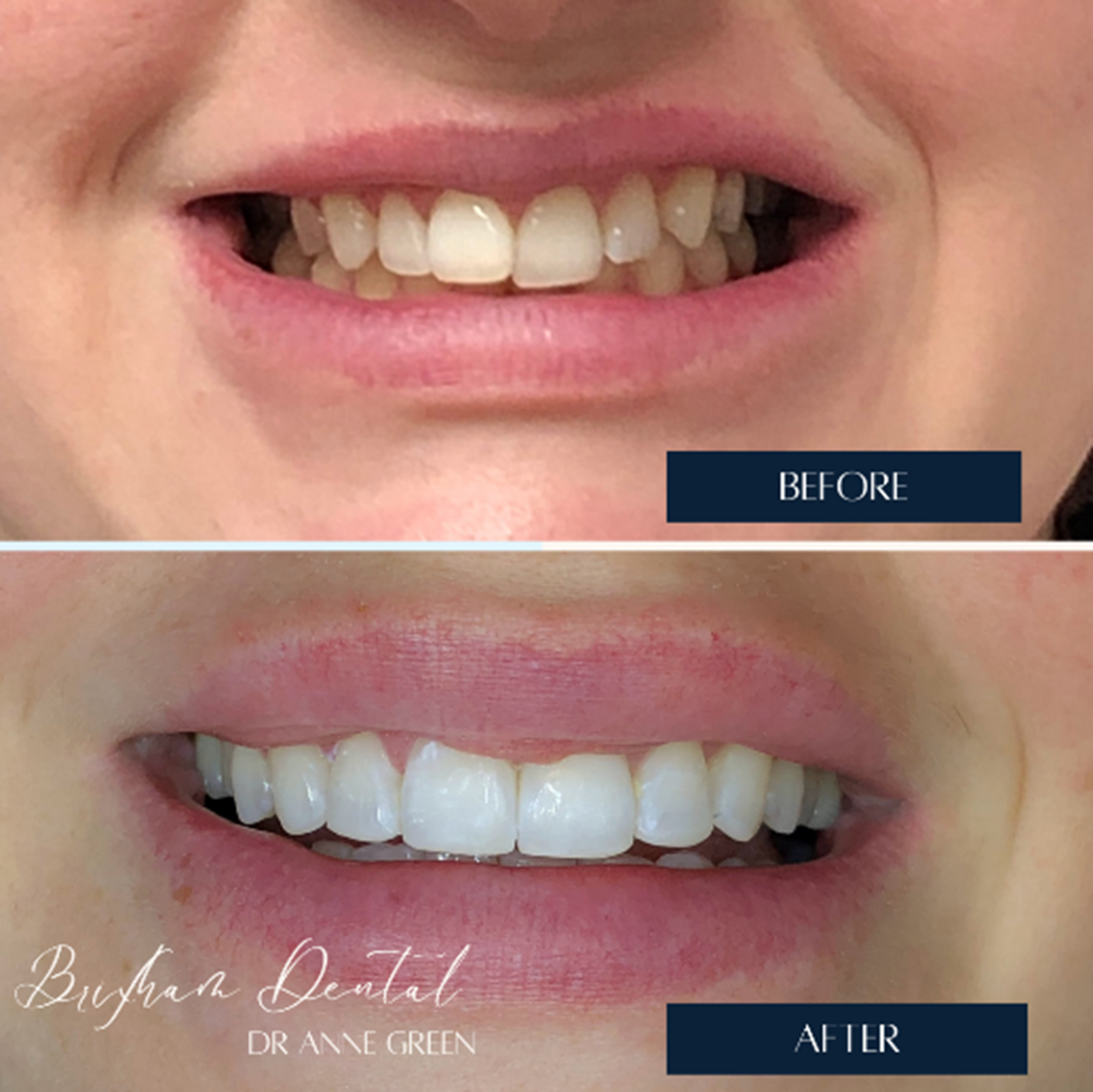 Before and after invisalign treatment