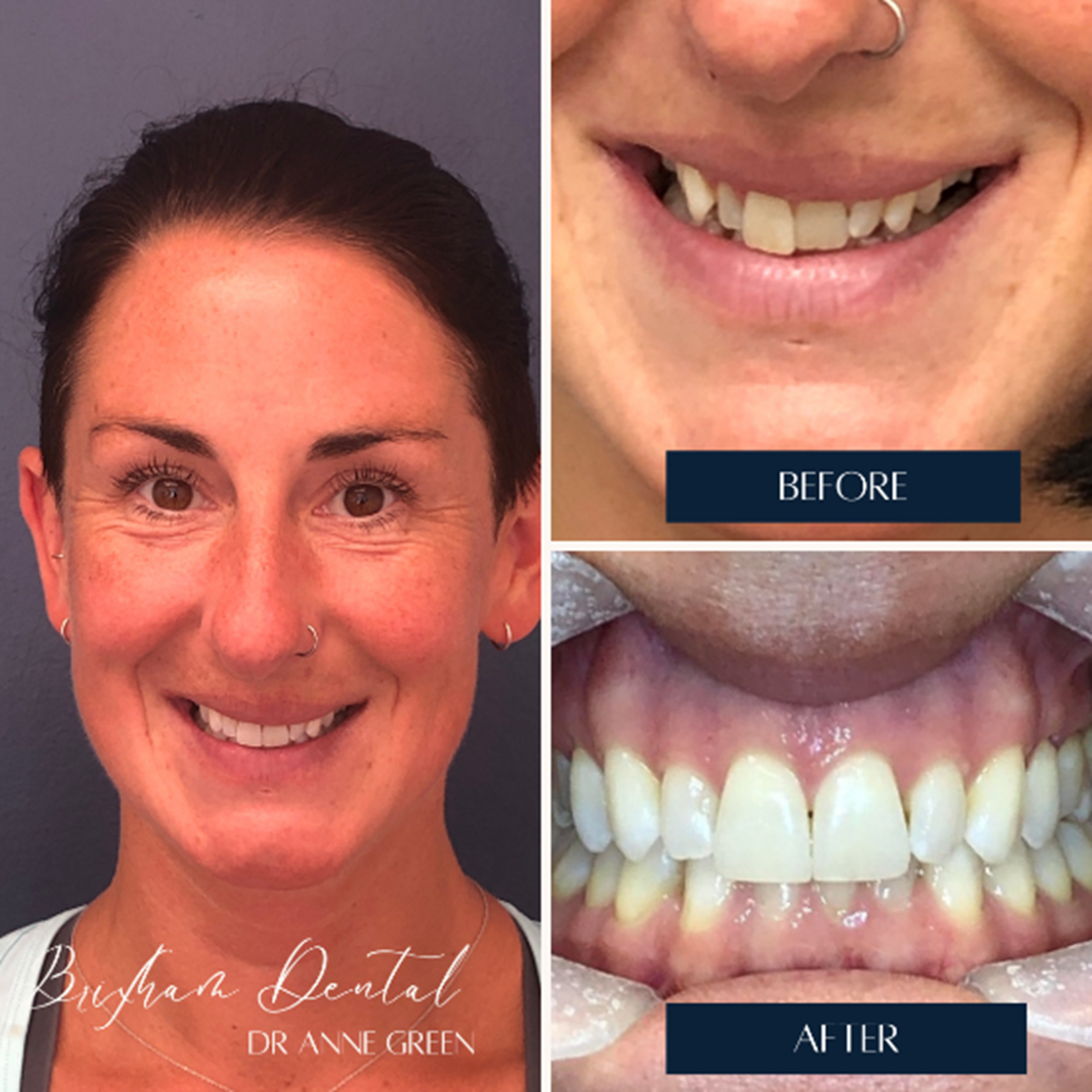 Before and after invisalign treatment