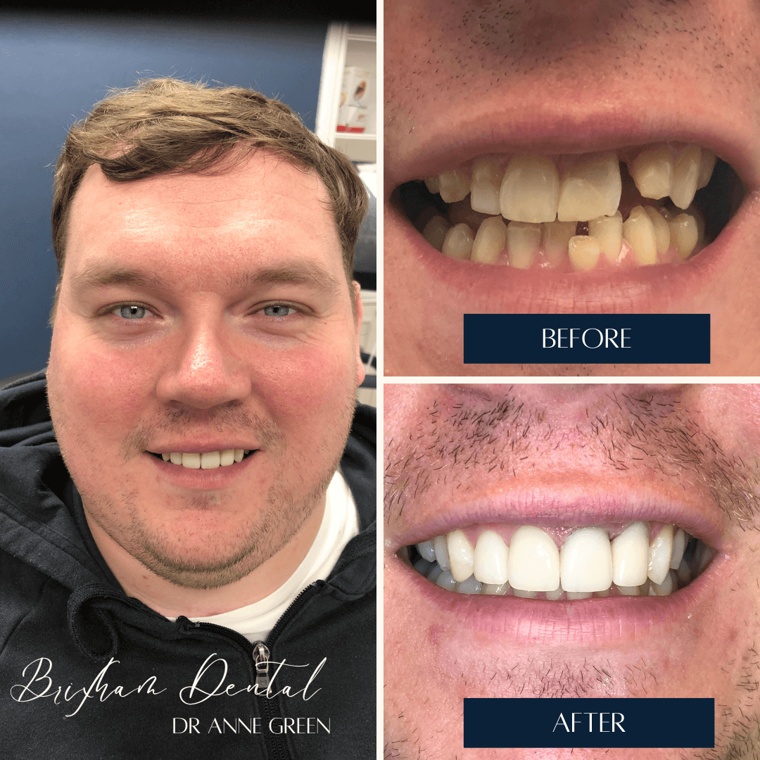 Before and after invisalign treatment