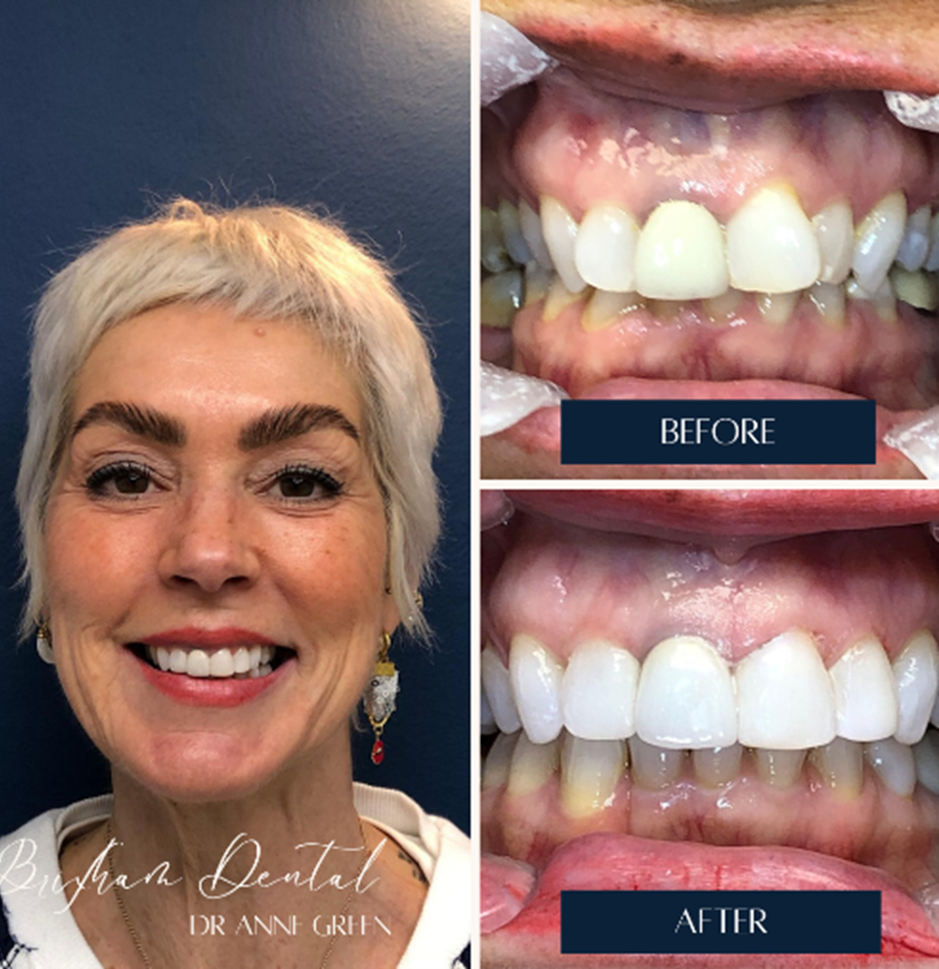 Before and after invisalign treatment