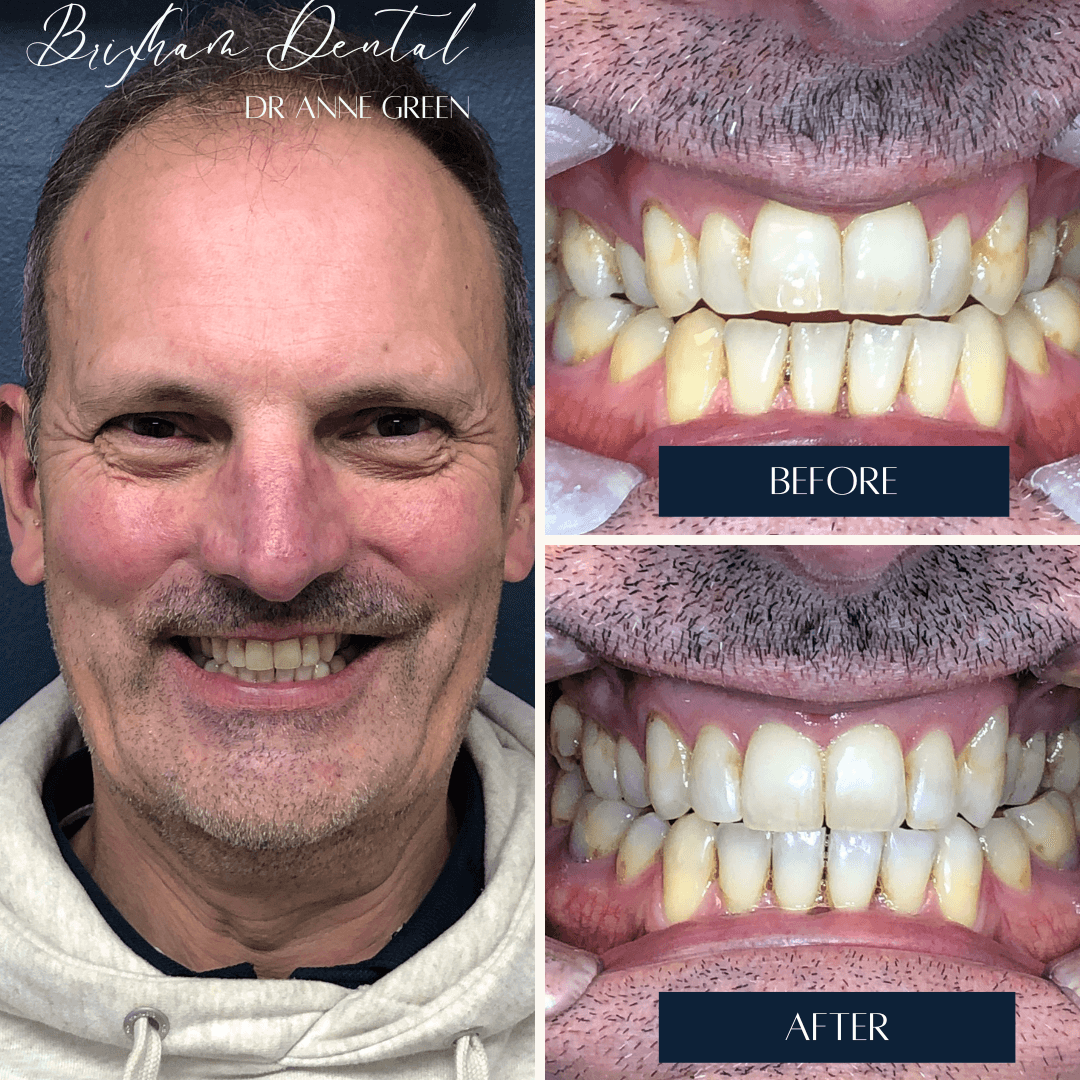 Before and after invisalign treatment