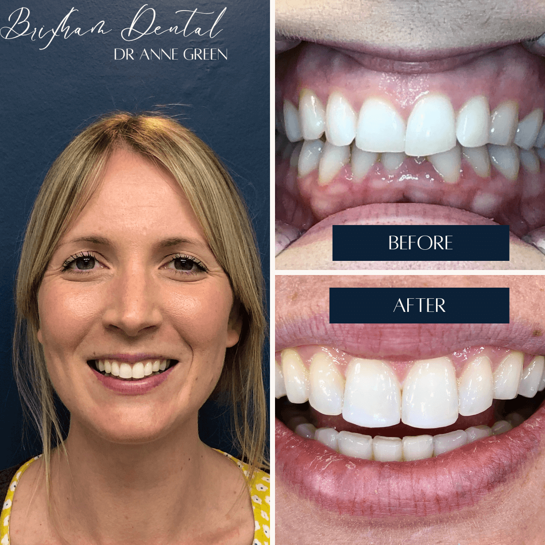 Before and after invisalign treatment