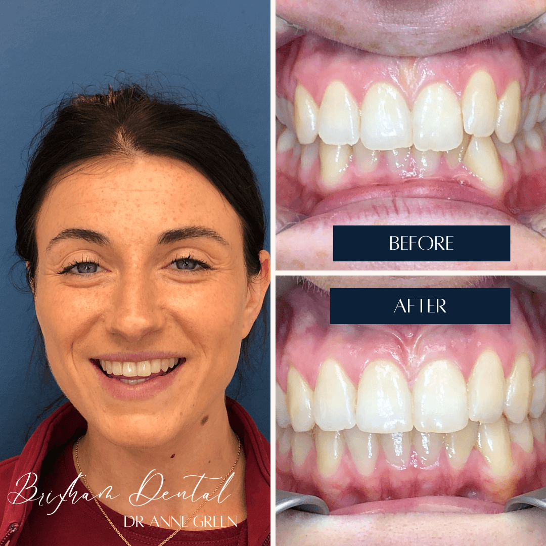 Before and after invisalign treatment