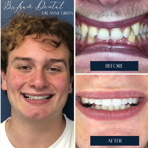 Before and after teeth whitening - Case 0