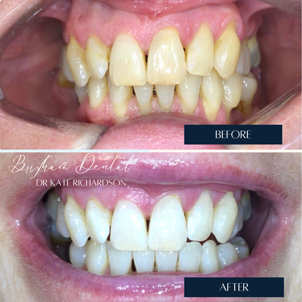 Before and after teeth whitening - Case 10