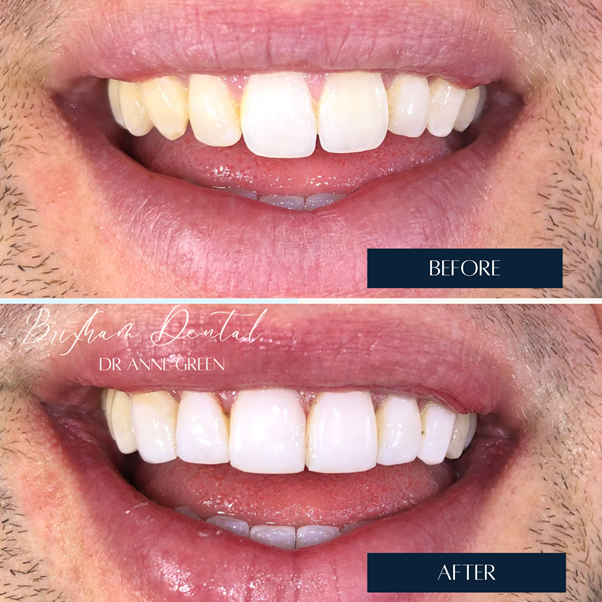 Before and after teeth whitening - Case 11