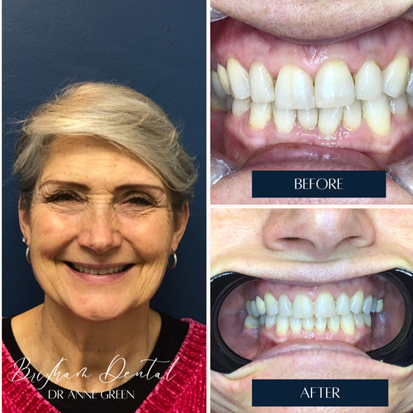 Before and after teeth whitening - Case 12