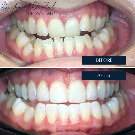 Before and after teeth whitening - Case 2