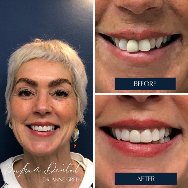 Before and after teeth whitening - Case 5