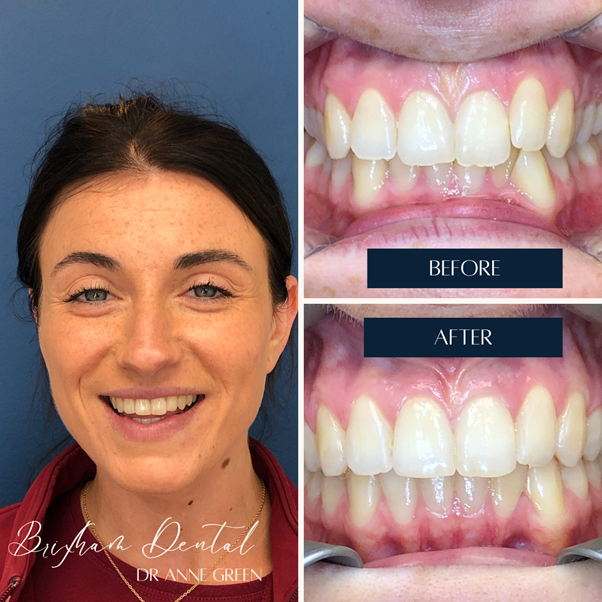 Before and after teeth whitening - Case 6