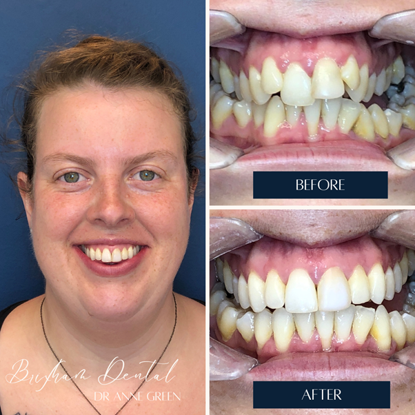 Before and after teeth whitening - Case 7