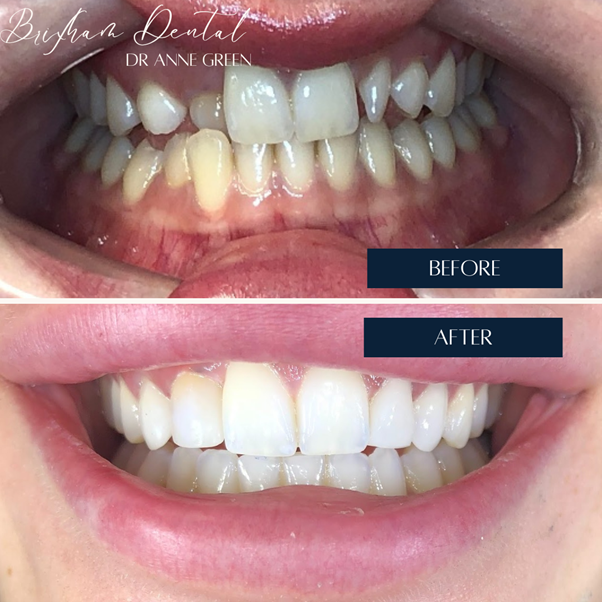 Before and after teeth whitening - Case 8
