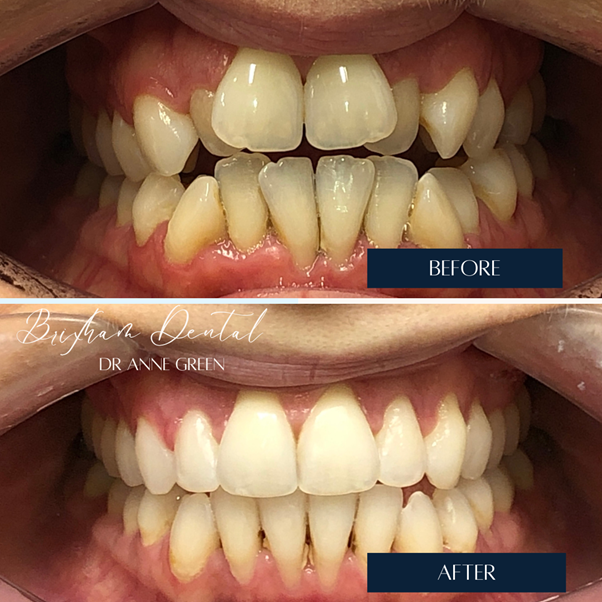 Before and after teeth whitening - Case 9