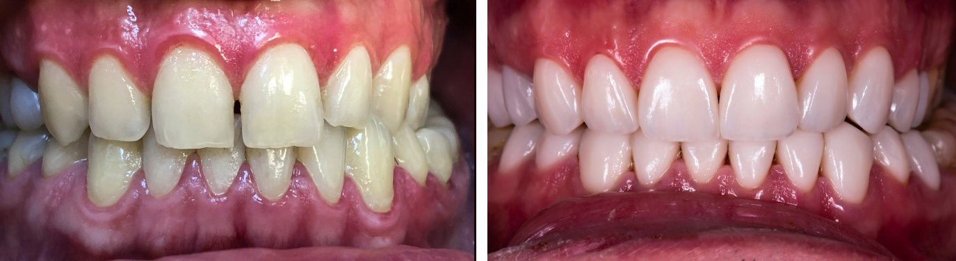 Before and after having veneers fitted